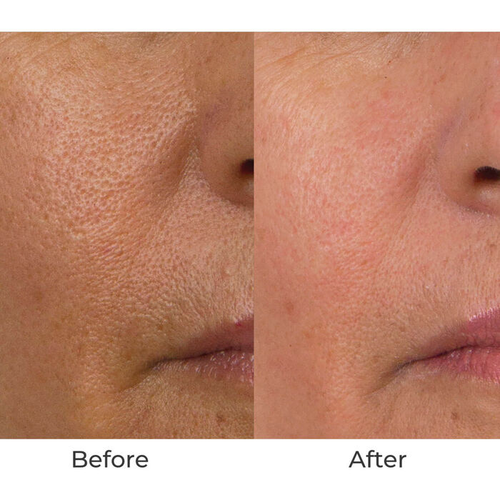 Conture CT Skin Toning System